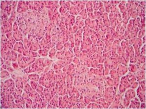 Figura 2- Aspecto histológico de processo inflamatório do parênquima pancreático.