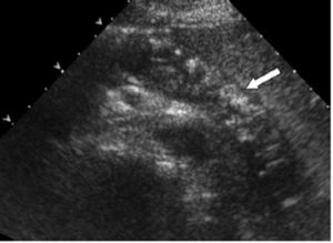 Figura 8- Ultrassonografia transabdominal do pâncreas demonstra uma glândula hipoecoica com múltiplas calcificações (flechas) ao longo da glândula.