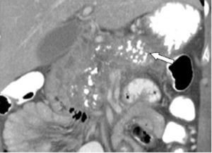 Figura 9- Tomografia computadorizada contrastada demonstrando múltiplas calcificações difusas (flecha) em um paciente portador de PC devido a abuso de álcool.