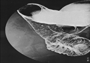 Figura 2- Enema opaco de duplo contraste evidenciando formações umbilicadas com falha de preenchimento do contraste caracterizando os nódulos linfoides hiperplasiados.