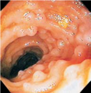 Figura 3- Visão endoscópica da mucosa ileal evidenciando os nódulos linfoides hiperplasiados.