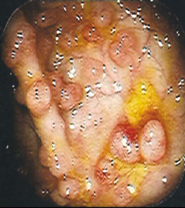 Figura 4- Visão endoscópica mais detalhada dos nódulos linfoides hiperplasiados.