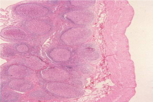 Figura 6- Visão à microscopia óptica comum em grande aumento de vários nódulos linfoides localizados na lâmina própria da mucosa ileal.