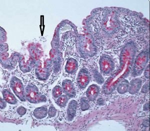 Figura 7- Material de biópsia do intestino delgado mostrando a presença de trofozoitas de Giardia na luz do intestino próximos a uma vilosidade diminuída em altura (seta). 