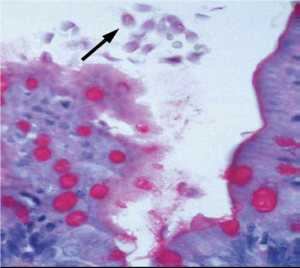 Figura 8- Material de biópsia do intestino delgado, em microscopia óptica comum, grande aumento, mostrando a presença de trofozoitas de Giardia na luz do intestino próximos a uma vilosidade (seta).  