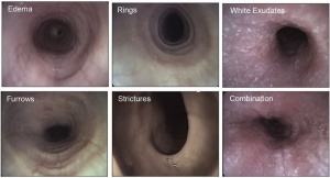  Figura 1-Imagens endoscópicas da EEo: a endoscopia pode detectar edema, placas esbranquiçadas e sulcos, os quais são marcadores da inflamação aguda, enquanto que os anéis e as estenoses representam a remodelação esofágica.