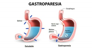 Figura 5- Representação esquemática comparativa entre o normal e a gastroparesia.