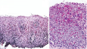 Figura 2- Microscopia óptica comum da mucosa esofágica: à esquerda aumento médio evidenciando intenso infiltrado eosinofílico, e, à direita em campo de grande aumento observa-se a formação de verdadeiro abcesso eosinofílico.