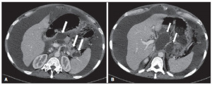 Cunha, EFC; Rocha, MS; Pereira, FP; Blasbalg, R; Baroni, RH. Necrose pancreática delimitada e outros conceitos atuais na avaliação radiológica da pancreatite aguda. Revista do Colégio Brasileiro de Radiologia e Diagnóstico por Imagem. 2014:47-3.