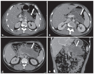 Figura 10 - Necrose pancreática delimitada (walled-off pancreatic necrosis). A,B: Imagens axiais de TC pós-contraste fase venosa. Evolução de pancreatite aguda necrosante. A: Extensa necrose do corpo e cauda pancreáticos de limites indistintos e com aspecto sólido (seta). B: Após duas semanas já pode ser identificada delimitação da área de necrose com aspecto liquefeito e com restos necróticos no seu interior (seta). C,D: Imagens axial (C) e coronal (D) de TC pós-contraste fase venosa. Homem de 42 anos com área de necrose parenquimatosa circunscrita substituindo corpo e cauda do pâncreas (setas), após três semanas da instalação do episódio de pancreatite aguda necrosante.