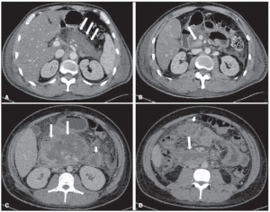 Cunha, EFC; Rocha, MS; Pereira, FP; Blasbalg, R; Baroni, RH. Necrose pancreática delimitada e outros conceitos atuais na avaliação radiológica da pancreatite aguda. Revista do Colégio Brasileiro de Radiologia e Diagnóstico por Imagem. 2014:47-3.