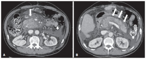 Cunha, EFC; Rocha, MS; Pereira, FP; Blasbalg, R; Baroni, RH. Necrose pancreática delimitada e outros conceitos atuais na avaliação radiológica da pancreatite aguda. Revista do Colégio Brasileiro de Radiologia e Diagnóstico por Imagem. 2014:47-3.