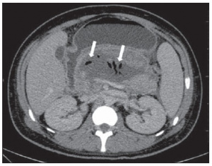 Cunha, EFC; Rocha, MS; Pereira, FP; Blasbalg, R; Baroni, RH. Necrose pancreática delimitada e outros conceitos atuais na avaliação radiológica da pancreatite aguda. Revista do Colégio Brasileiro de Radiologia e Diagnóstico por Imagem. 2014:47-3.