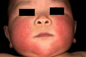 Figura 6- Imagem de recém-nascido apresentando Eritema tóxico.