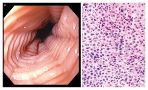 Figura 1- Imagem endoscópica do esôfago apresentando traqueização (E); microfotografia de grande aumento da mucosa esofágico apresentando número aumentado de infiltração eosinofílica (D).