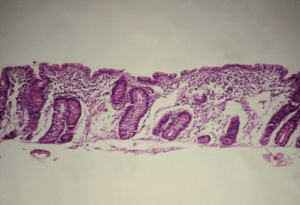 Figura 2A- Biópsia de intestino delgado revelando atrofia vilositária total e hiperplasia das criptas.