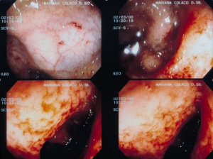 Figura 11- Lesões inflamatórias colônicas com friabilidadae da mucosa em paciente portador de Colite Alérgica.