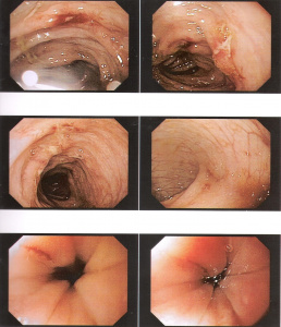 Figura 10- Lesões aftosas colônicas visualizadas em um paciente portador de Colite Alérgica.
