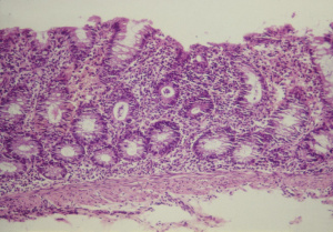 Figura 12- Microfotografia em microscopia óptica comum da mucosa colônica evidenciando intenso processo inflamatório, inclusive com a presença de abcesso críptico.