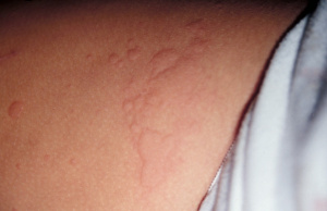 Figura 3- Lesões eritemato-papulosas disseminadas no tronco do paciente alérgico ao amendoim.