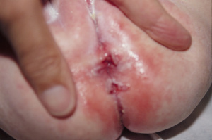 Figura 2- Lesões típicas de proctocolite alérgica.