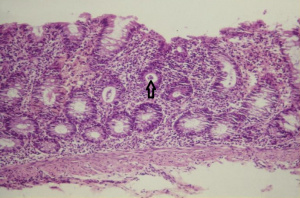 Figura 2- Microfotografia da mucosa colônica evidenciando erosão do epitélio, aumento do infiltrado linfo-plasmocitário na lâmina própria, diminuição do conteúdo de muco nas glândulas crípticas e presença de polimorfonucleares no interior da glândula críptica (abscesso críptico - seta)