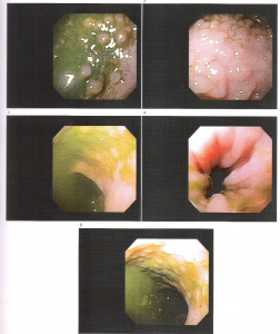 Figura 4- Mucosa colônica evidenciando a presença de nódulos linfóides hiperplasiados.