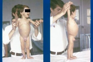 Figura 2 - Nosso primeiro paciente com DC no momento da internação evidenciando desnutrição grave e grande irritabilidade..
