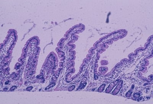 Figura 8- Microfotografia de biópsia do intestino delgado, em microscopia óptica comum, grande aumento, de paciente portador de Doença Celíaca 6 meses após início da dieta isenta de glúten. As vilosidades intestinais encontram-se digitiformes, as glândulas crípitcas normais e o infiltrado linfo-plasmocitário da lâmina própria discreto, células epiteliais cilíndricas com núcleo em posição basal e glândulas crípticas preservando a relação vilosidade/cripta 4ou5:1. Presentemente, os critérios diagnósticos de graduação das alterações morfológicas da mucosa intestinal aceitos internacionalmente para o diagnóstico da DC são os propostos por Marsh, em 1992 (Figuras 9-10).