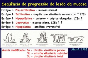 Figura 9 - Representação esquemática dos critérios de Marsh para o diagnóstico da Doença Celíaca.