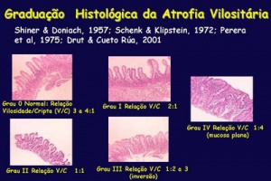 Figura 10 - Graduação histológica das lesões do intestino delgado na Doença Celíaca.