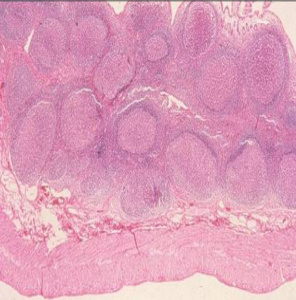 Figura 5- Microfotografia da mucosa colônica evidenciando além dos nódulos difusos em paciente portador de PA.