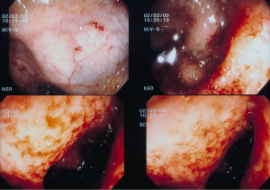 Figura 2- Visualização endoscópica das mucosas colônica e ileal evidenciando ulcerações macroscópicas, sangramento espontâneo e ingurgitamento vascular.