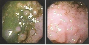 Figura 4- Fotografia da mucosa colônica evidenciando a formação de múltiplos nódulos em um paciente portador de PA. 