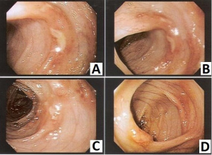 Figura 6- Fotografias da mucosa colônica evidenciando a presença focal de lesões aftosas em paciente portador de PA.