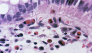 Figura 9 – Microfotografia em grande aumento de espécime de biópsia retal em microscopia óptica comum evidenciando grande infiltrado eosinofílico na lâmina própria, e, também permeando o epitélio retal. Determinação da Calprotectina fecal, solicitada para os últimos 30 pacientes, revelou a média de 385 mg/kg, mediana de 284, com variação de 2 a 1143.