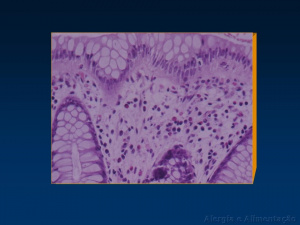 Figura 15- Microfotografia de espécime de biópsia retal da referida paciente evidenciando aumento do infiltrado linfo-plasmocitário na lâmina própria e número significativamente aumentado de infiltrado eosinofílico.