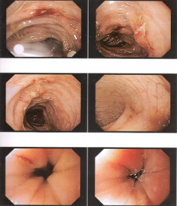 Figura 7- Fotografias da mucosa colônica evidenciando hiperemia difusa e lesões aftosas em paciente portador de PA.