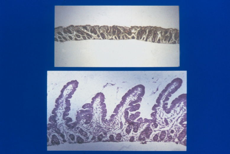 Figura 11- Fragmentos de biópsia de intestino delgado revelando a foto superior atrofia vilositária subtotal, e, na inferior a recuperação morfológica apresentando vilosidades digitiformes e uma relação vilosidade/cripta 4/1